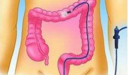 肠镜怎么做的过程视频,直观视频带你了解每一步